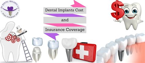 Dental Implant Costs And Insurance Coverage Oc Dental Implants Dental Implant Costs And Insurance Coverage Oc Dental Implants