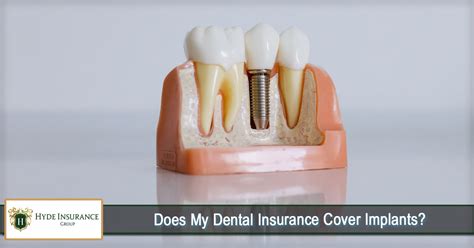 Dental Insurance Covering Implants